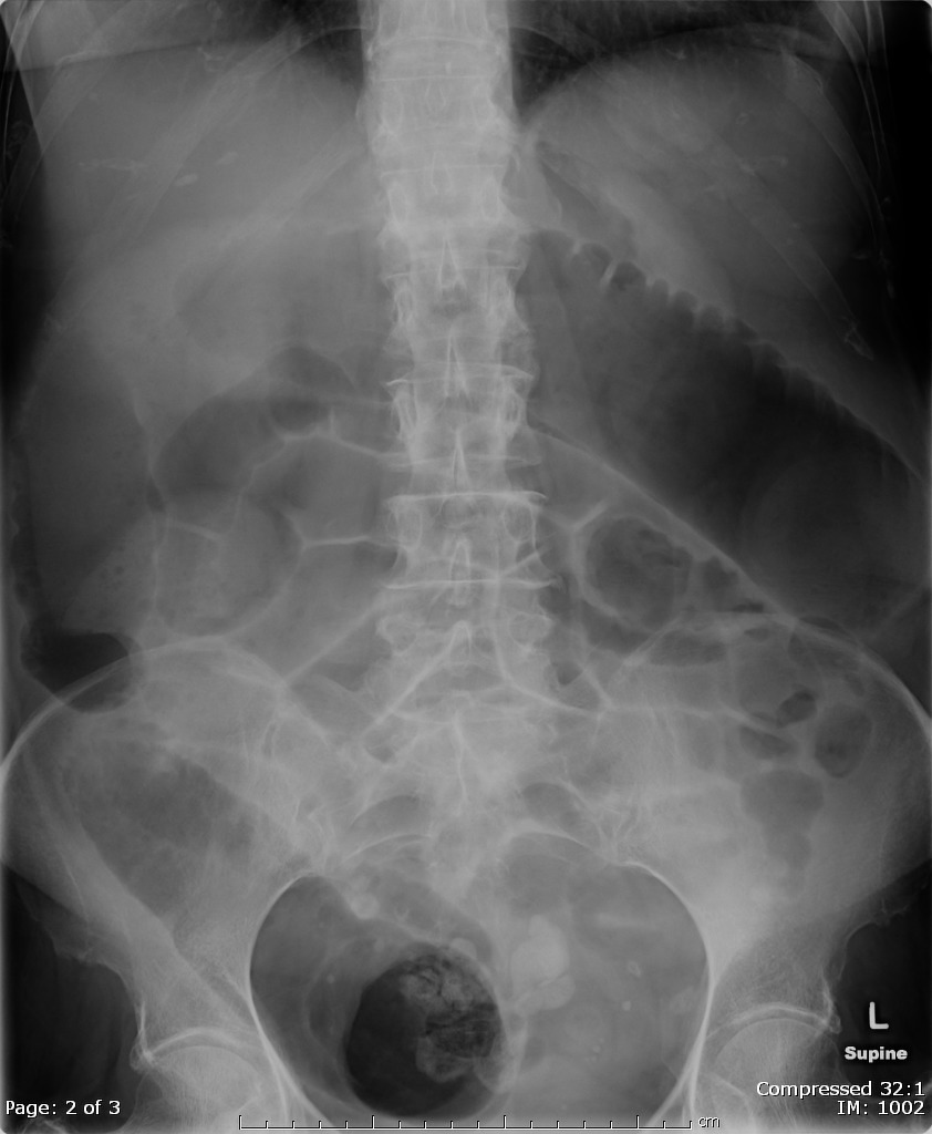 Abdominal X Ray Colon Cancer