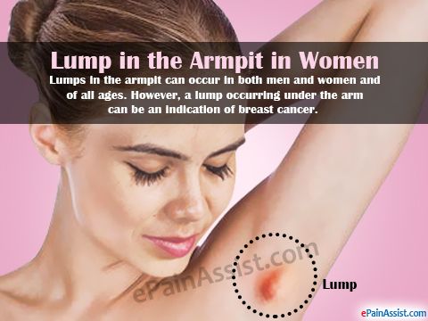 Armpit Breast Cancer Lumps