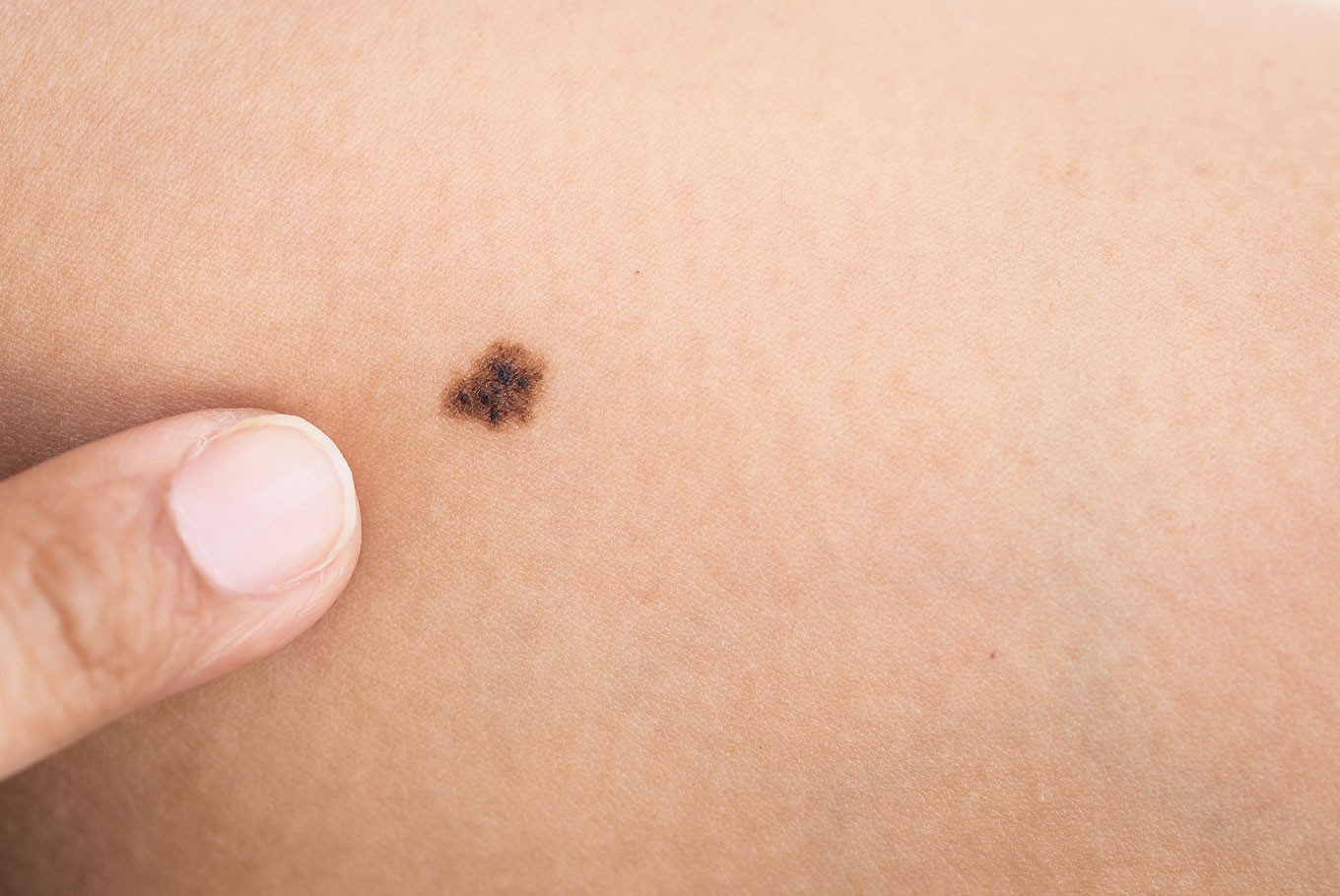 Back Cancerous Moles Early Signs