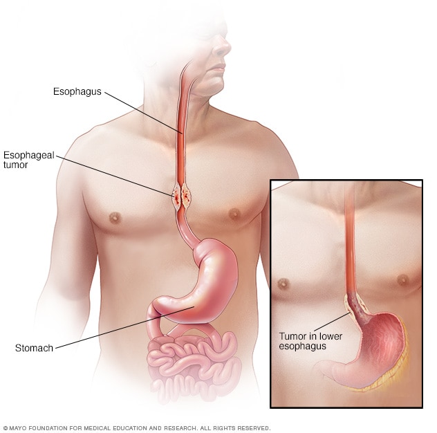 Barretts Esophagus Cancer Symptoms