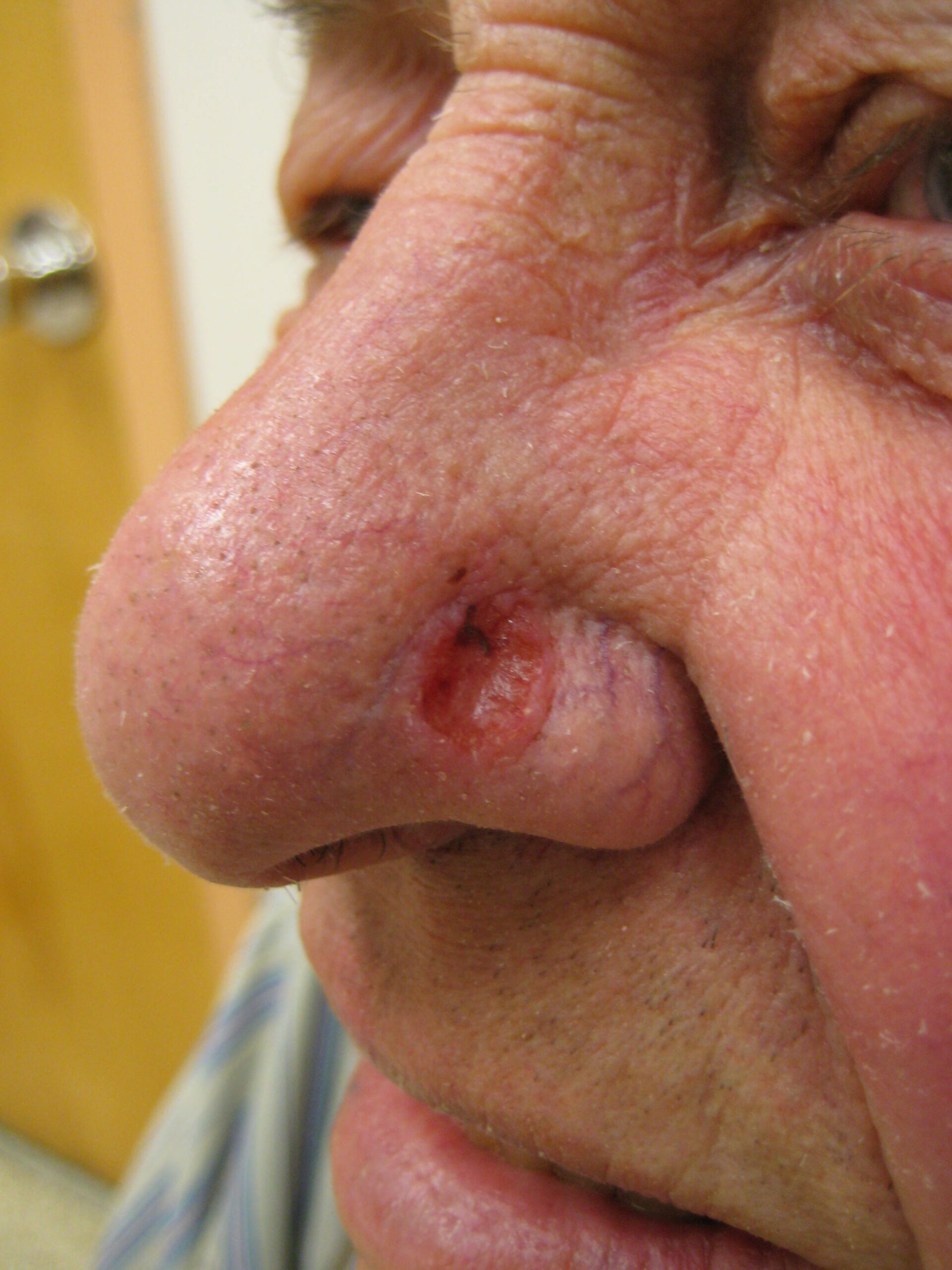 Basal Cell Cancer Nose Treatment