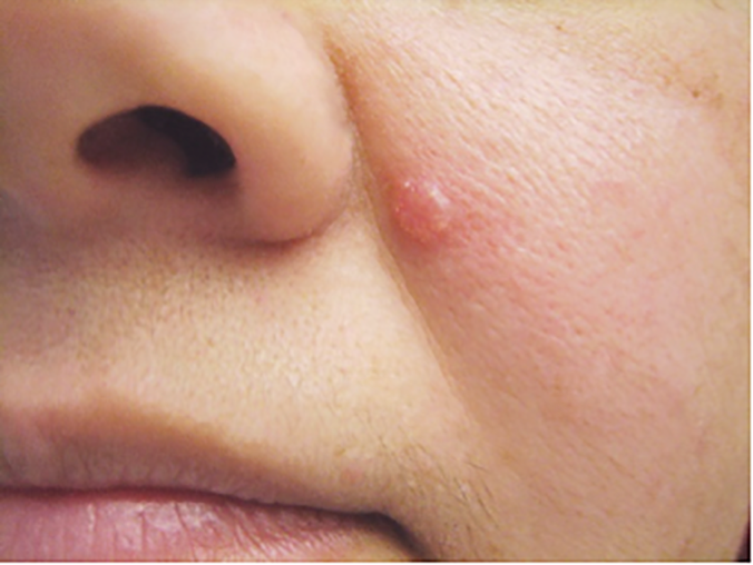 Basal Cell Cancer Nose