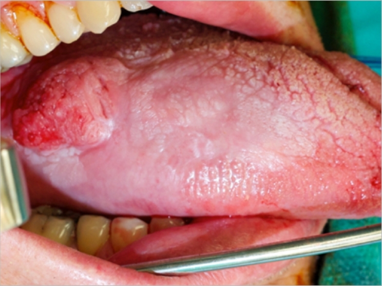 Base Of Tongue Cancer Pictures