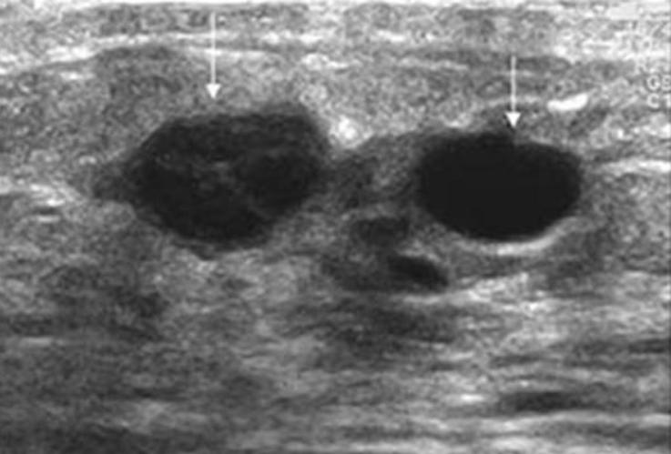 Benign Breast Cancer Vs Cyst Ultrasound Images