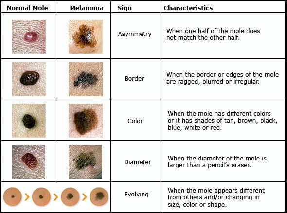 Black Cancer Spots On Dogs