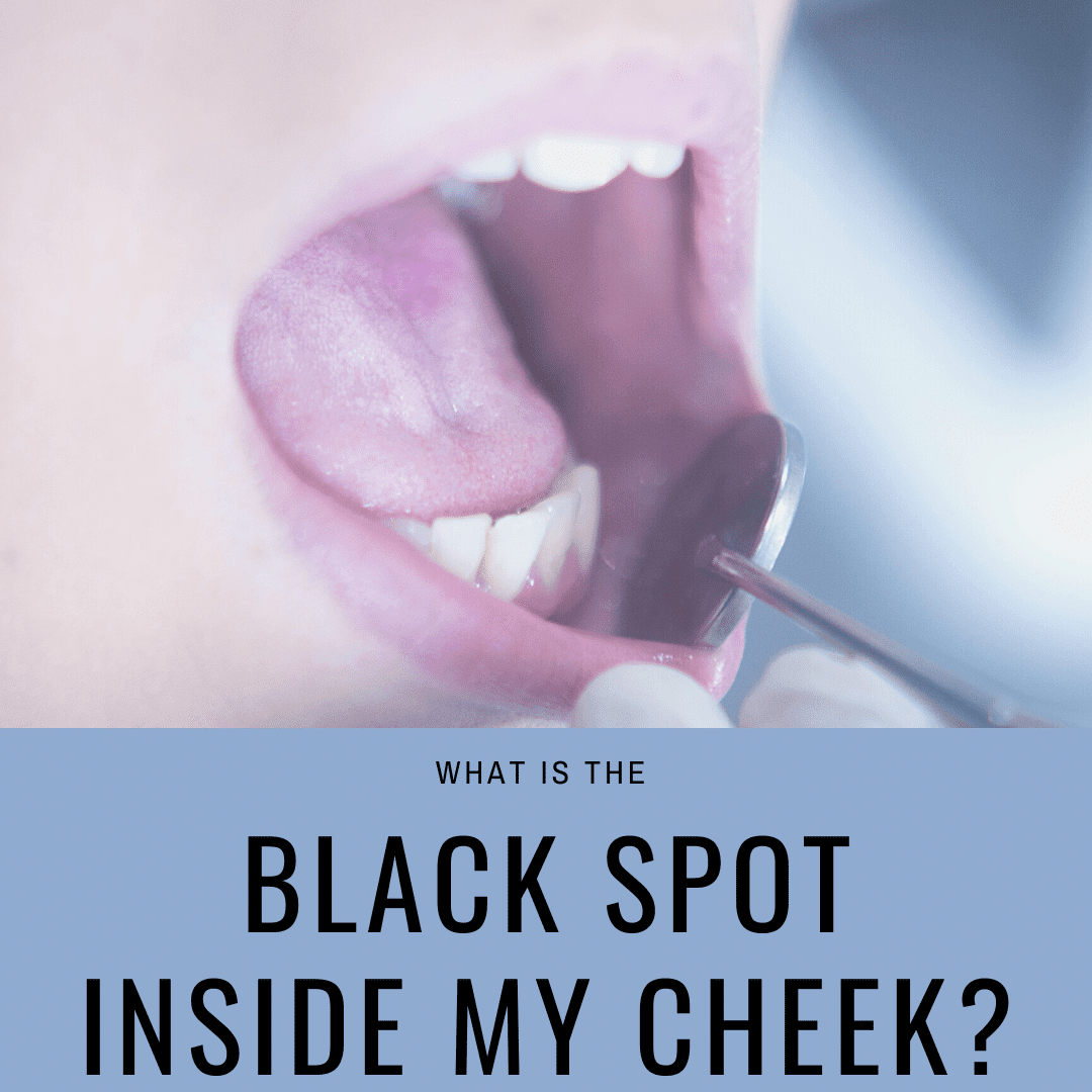 Black Spot Inside Cheek Cancer