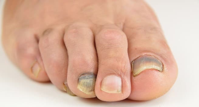 Black Under Toenail Cancer