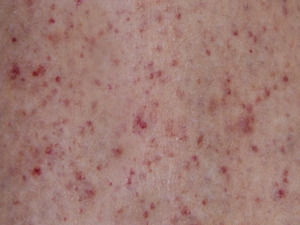 Blood Cancer Red Spots On Skin