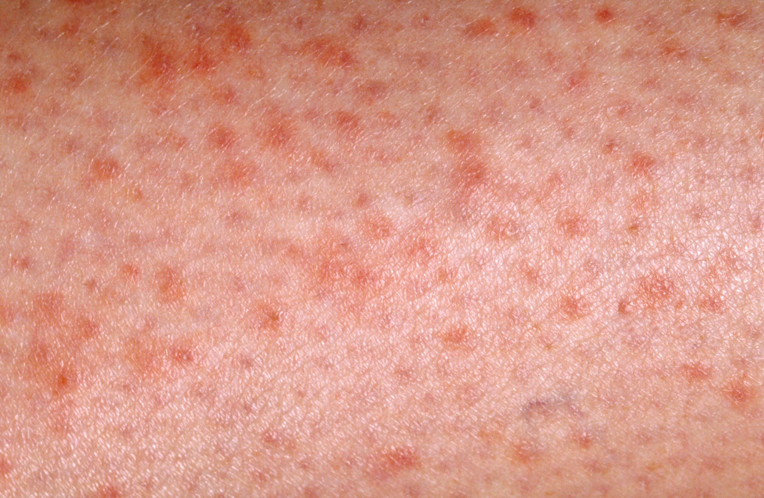 Blood Cancer Skin Rash Pictures