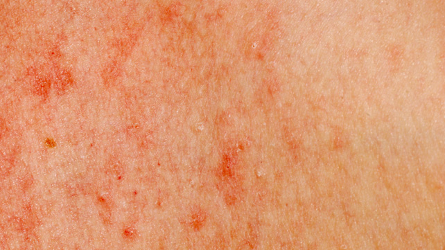 Blood Cancer Spots On Skin