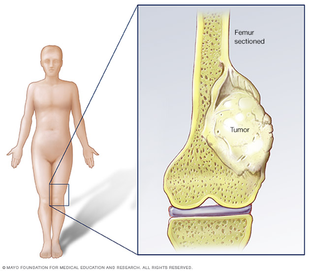 Bone Cancer Lump On Leg