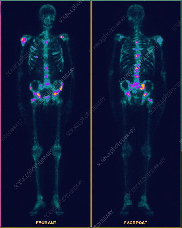 Bone Cancer Pet Scan Images