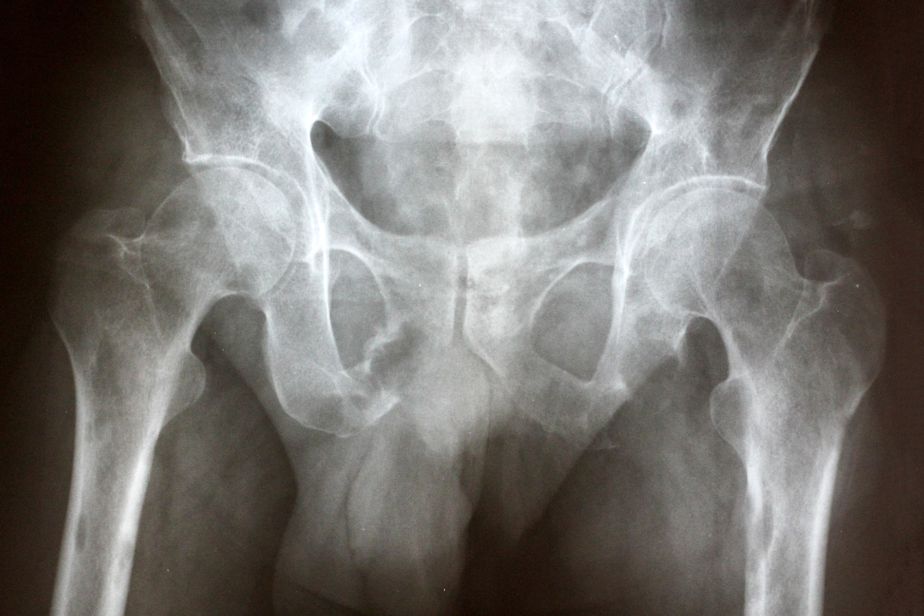 Bone Cancer X Ray Images