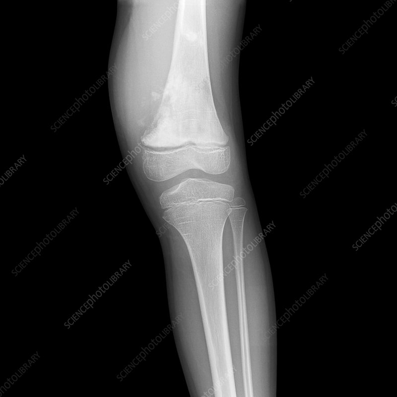 Bone Cancer X Ray Leg