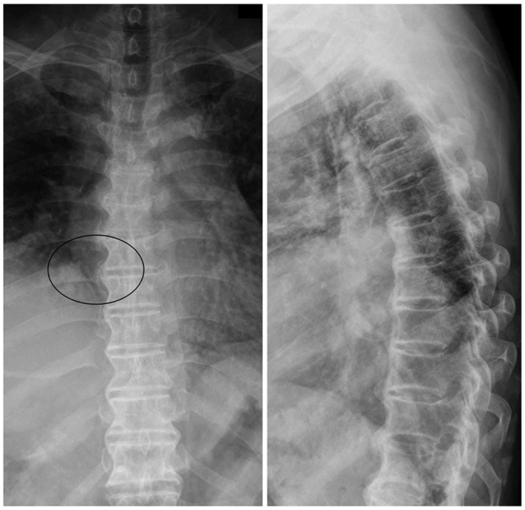 Bone Cancer X Ray Spine