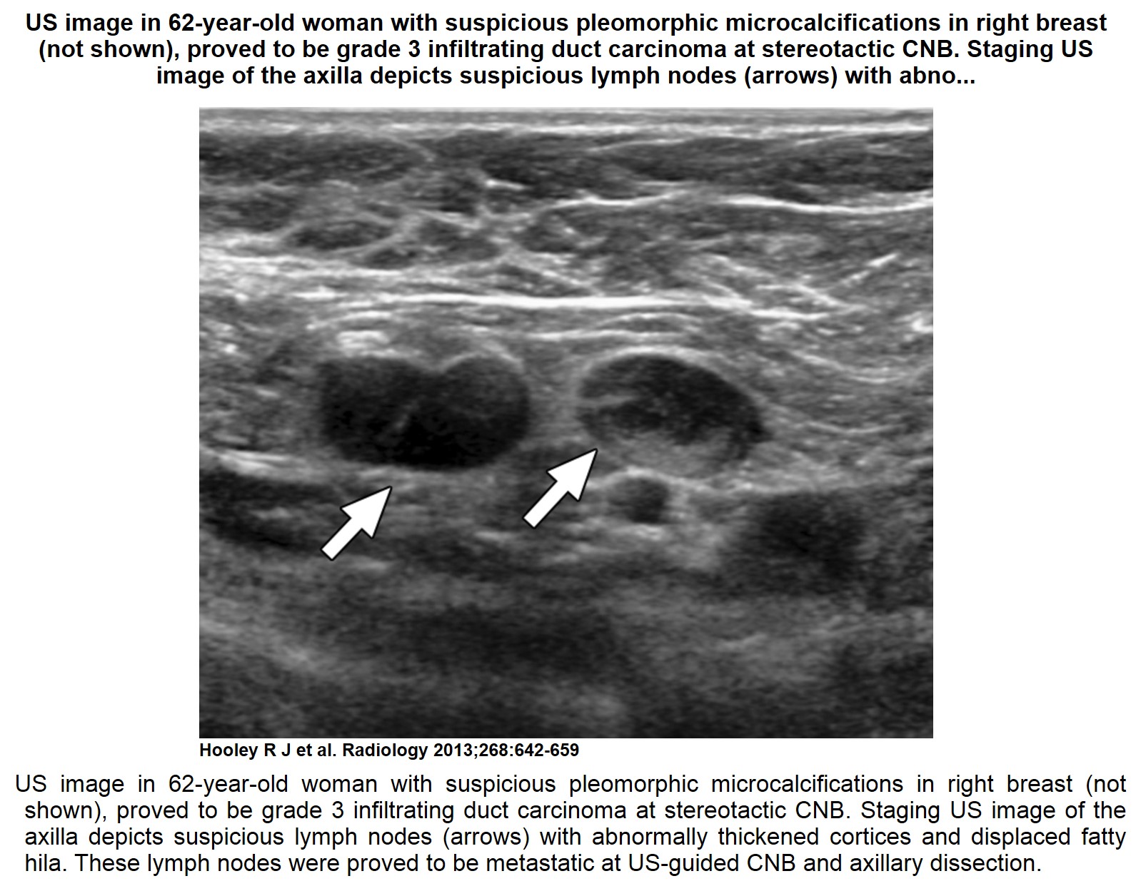 Breast Cancer Characteristics On Ultrasound