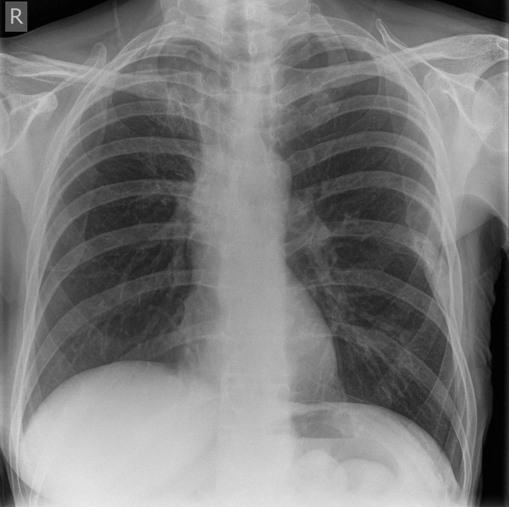 Breast Cancer Chest X Ray