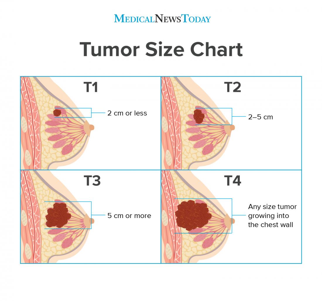 Breast Cancer Growth Rate Chart