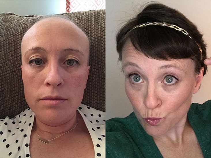 Breast Cancer Hair Loss Advice