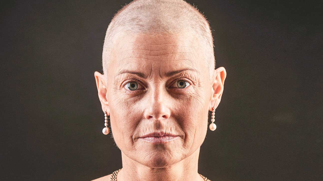 Breast Cancer Hair Loss