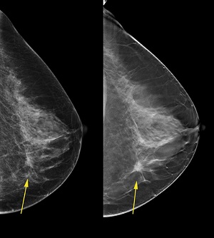 Breast Cancer Images On 3d Mammogram