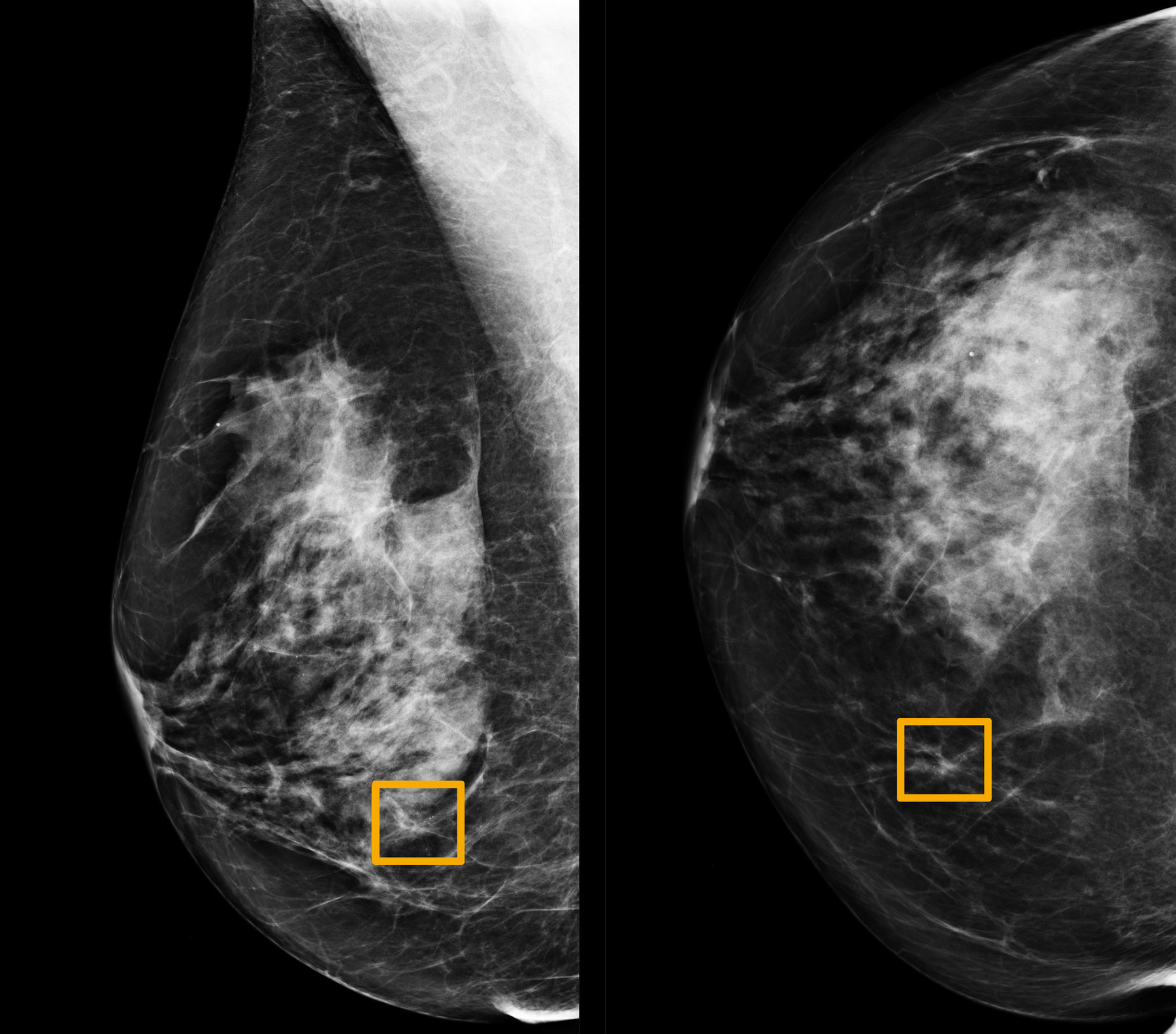 Breast Cancer Images On Mammogram