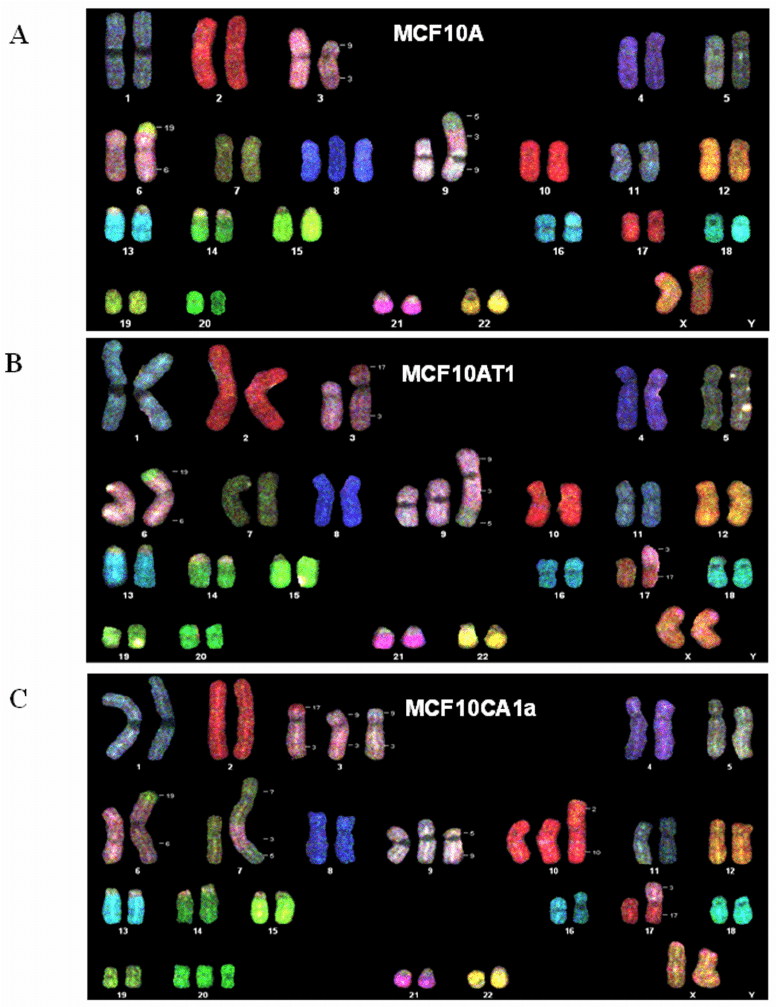 Breast Cancer Karyotype