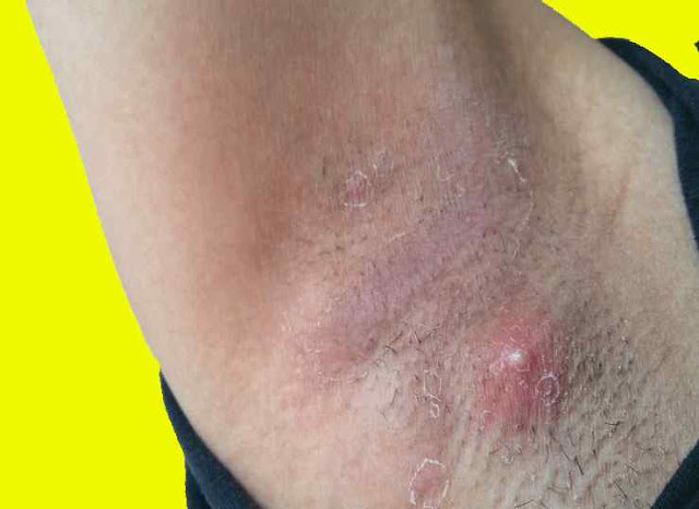 Breast Cancer Lump Under Armpit