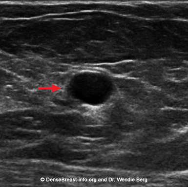 Breast Cancer Lumps Ultrasound Pictures