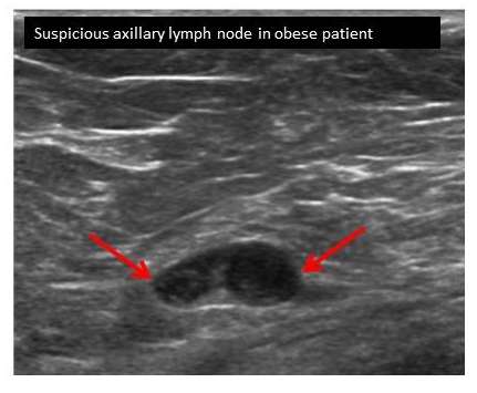 Breast Cancer Lymph Nodes Ultrasound