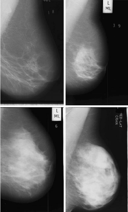 Breast Cancer Mammogram Images Database