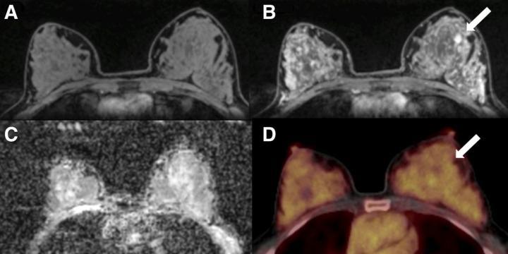 Breast Cancer Mri With Contrast