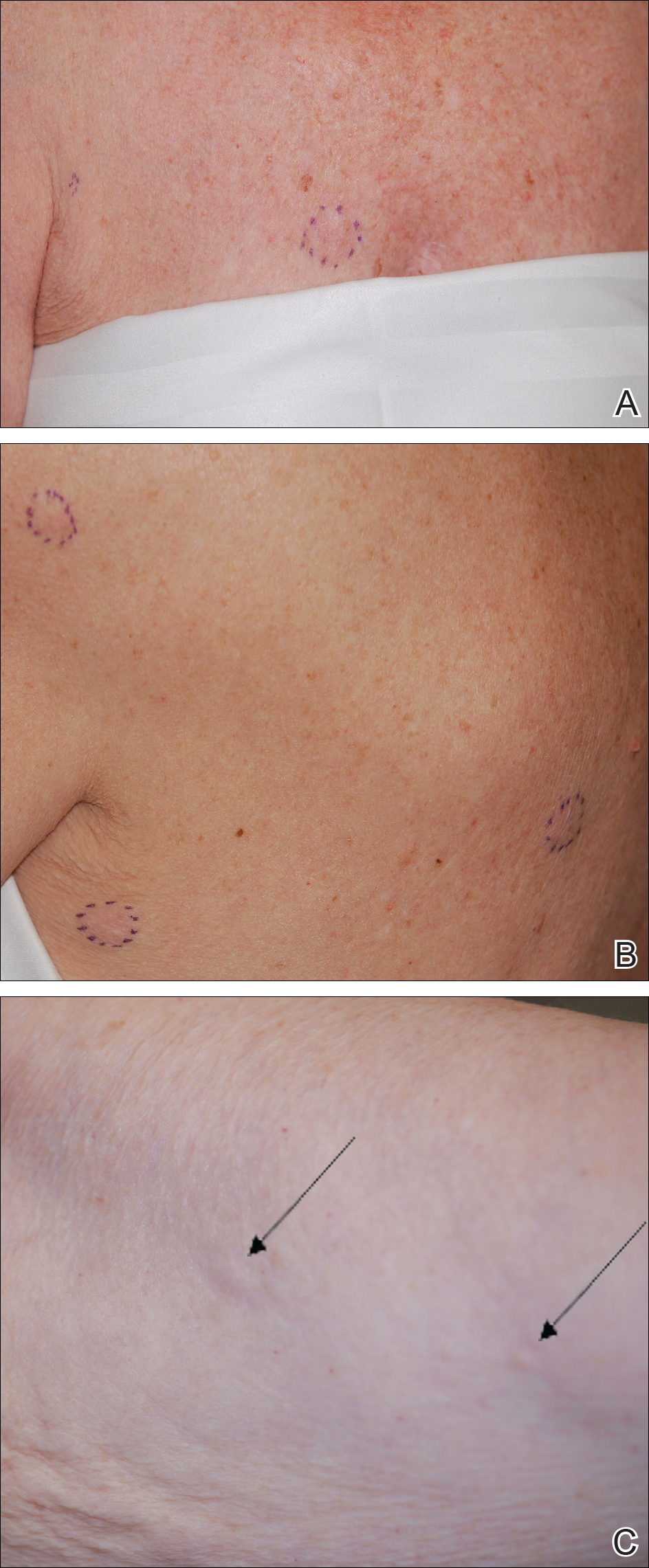 Breast Cancer On Skin Surface