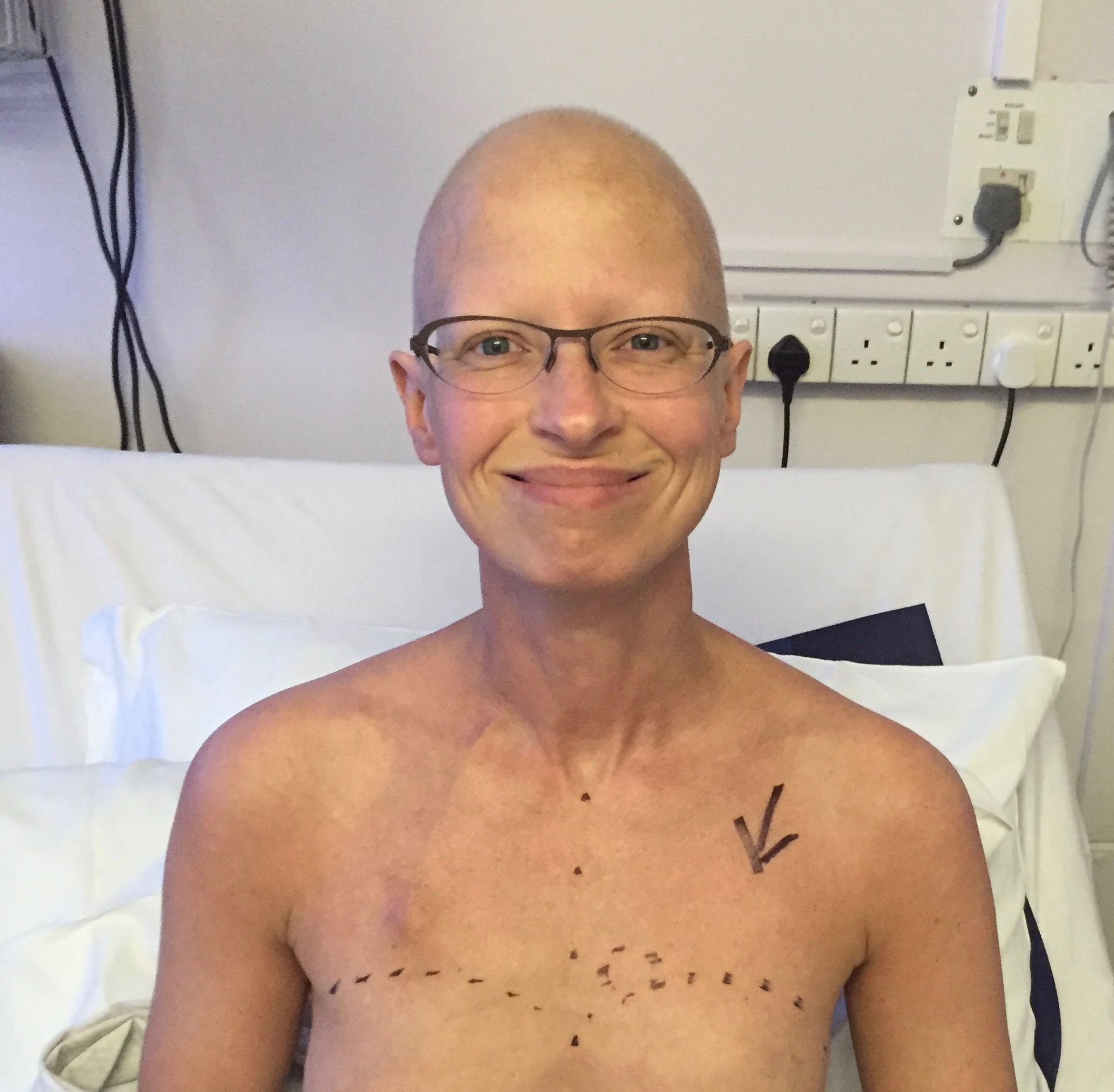 28+ Chemotherapy For Breast Cancer Stage 1
 Pics