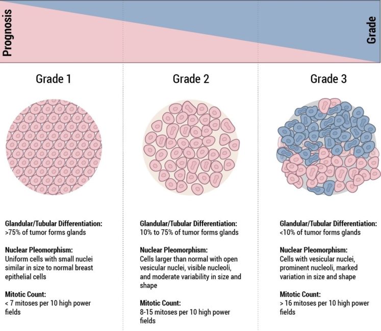 44+ Different Grades Of Breast Cancer
 Pics